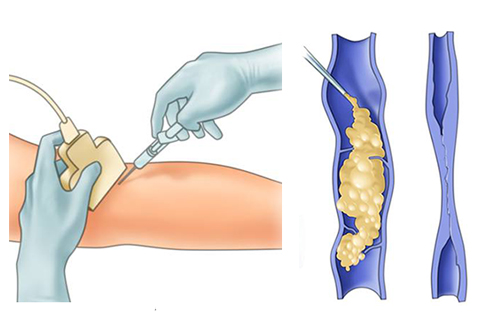 ভেরিকোজ ভেইনস এর চিকিৎসা কীভাবে হয়ে থাকে