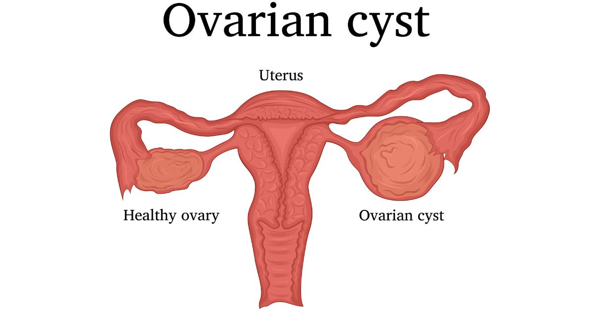 ডিম্বাশয়ের সিস্ট: কারণ এবং উপসর্গ
