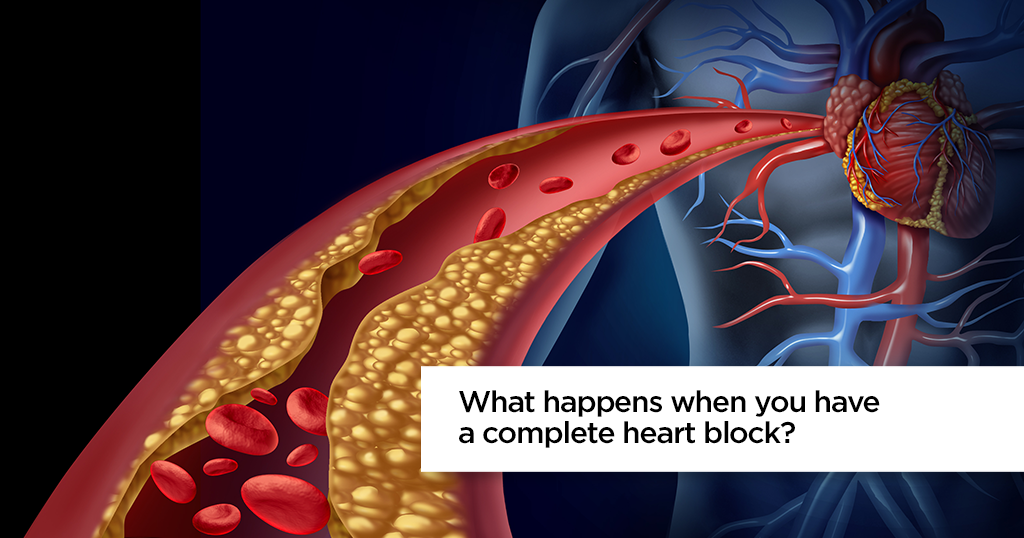 क्या होता है जब आपका संपूर्ण हृदय ब्लॉक हो जाता है?