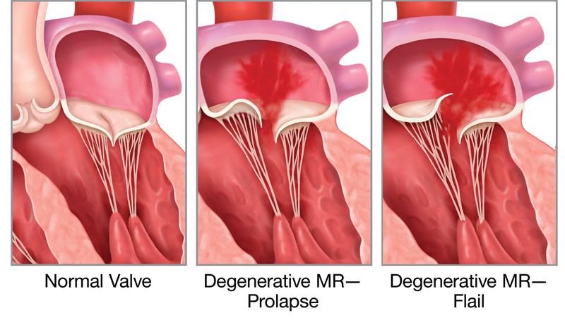 மிட்ரல் வால்வு நோய்