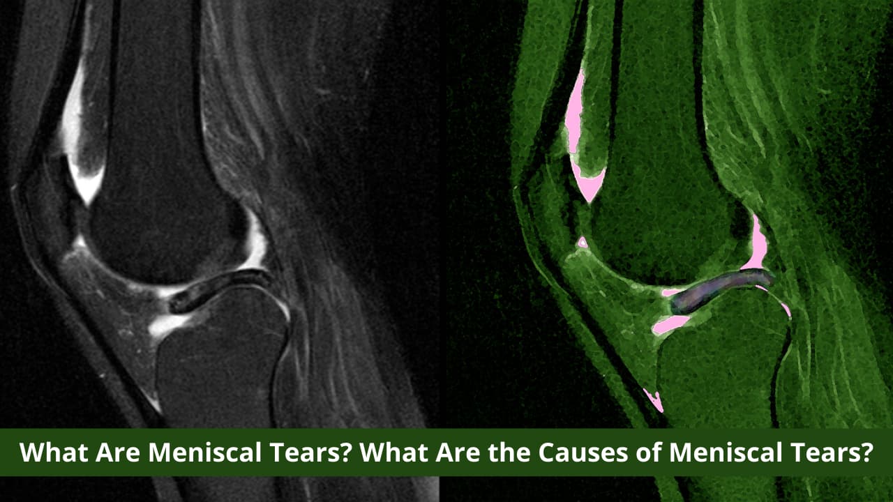 மெனிஸ்கல் கீறல் என்றால் என்ன? மெனிஸ்கல் கீறல் வருவதற்கான காரணங்கள் என்ன?