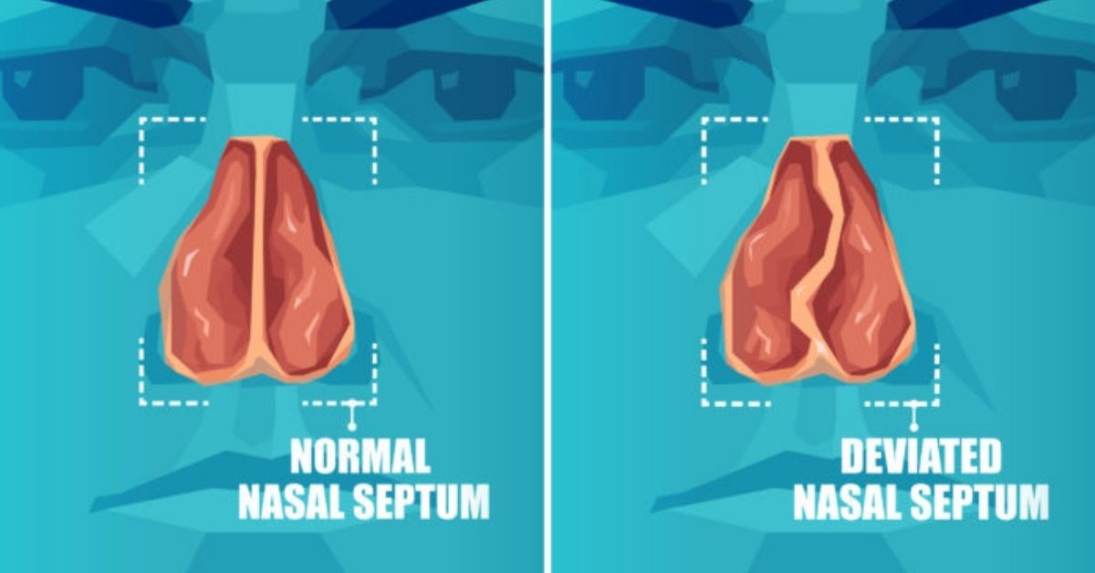 நாசி செப்டம் விலகல் – அறிகுறிகள், காரணங்கள் மற்றும் சிகிச்சை