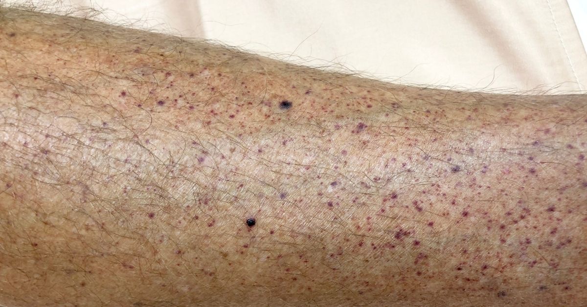 Petechiae – காரணங்கள், சிகிச்சை மற்றும் தடுப்பு