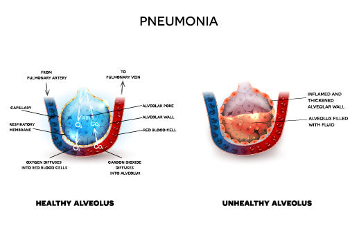 న్యుమోనియా – కారణాలు, లక్షణాలు మరియు చికిత్స